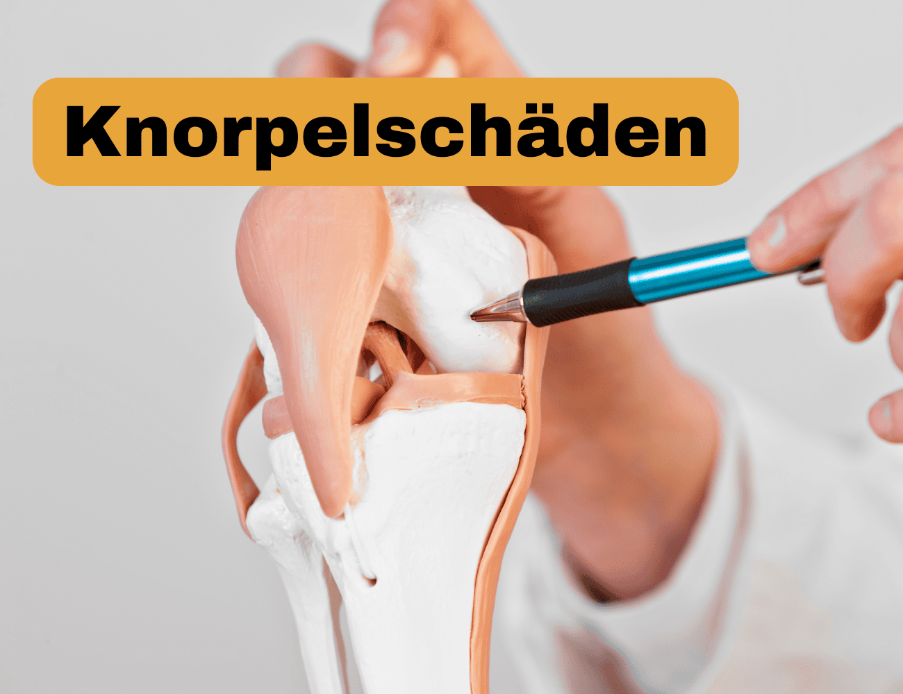 Knorpelschäden am Kniegelenk: Formen, Symptome, Ursachen und Therapiemöglichkeiten